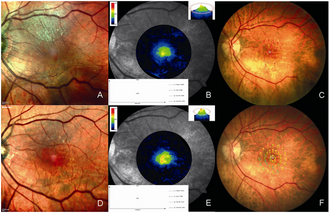 macular pigment optical density