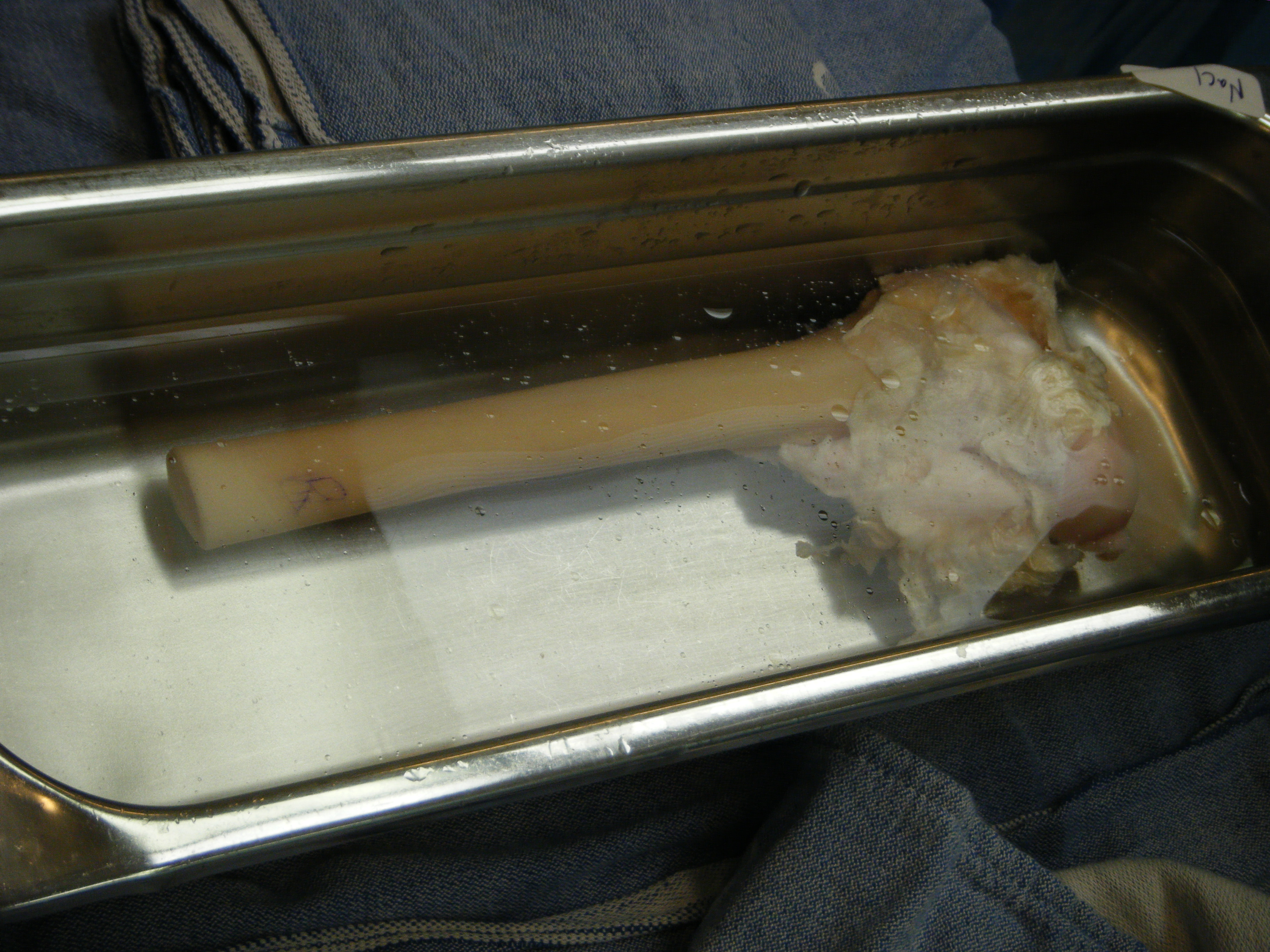 An allograft with tissue on the upper portion, the tissue is kept for adults that have a slower cell regeneration and is removed for young adults.