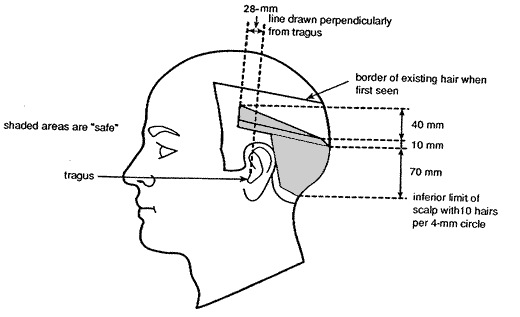 Parameters of the Safe Donor Area (depicted by the shaded region above)