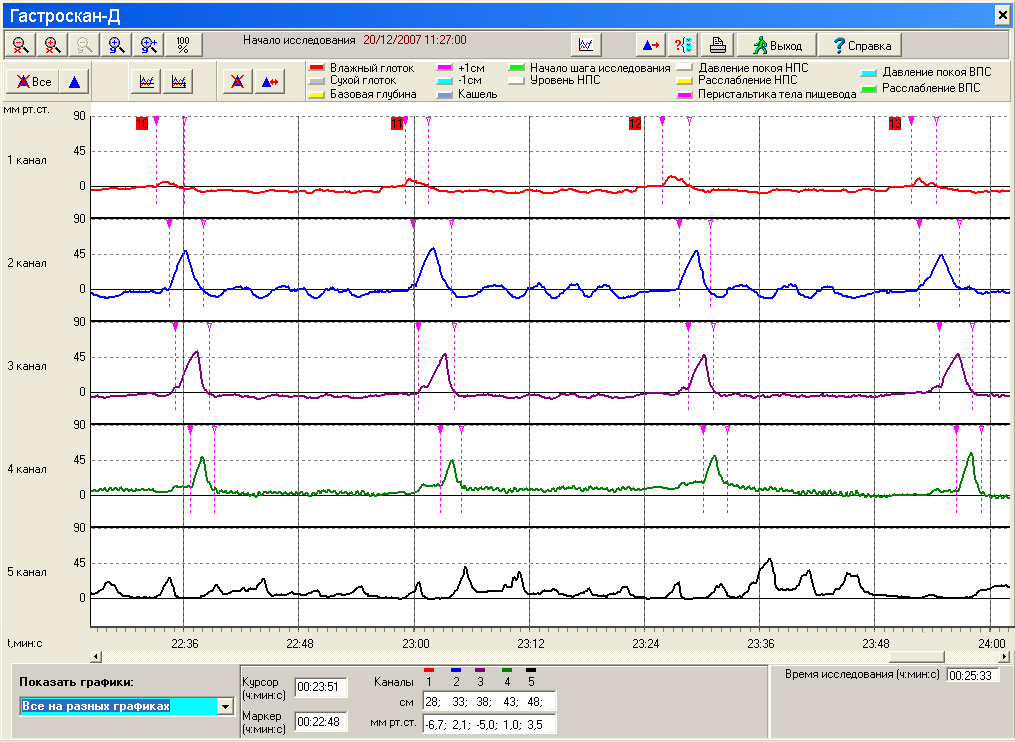 Graphs of pressure in different parts of the esophagus during swallowing, obtained by GastroScan-D